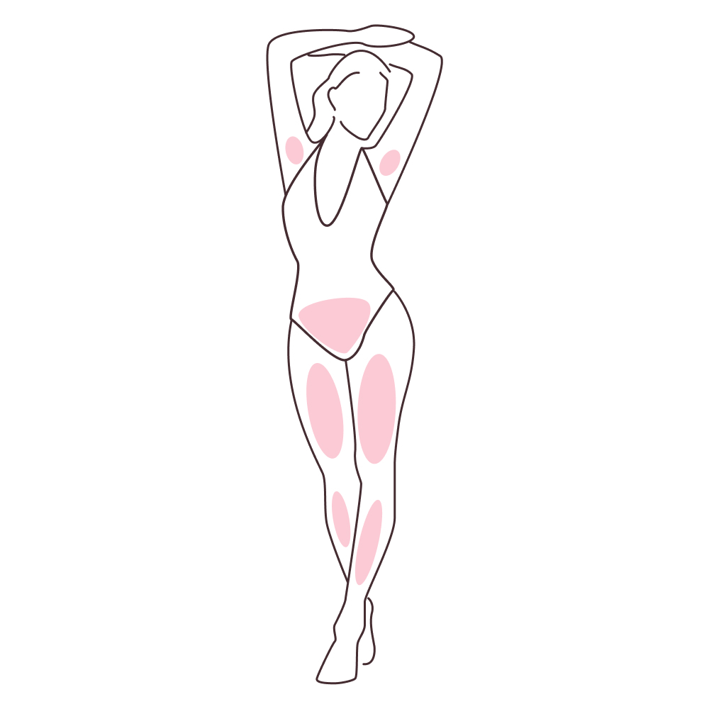 depilacja laserowa całe nogi + bikini głębokie + pachy 