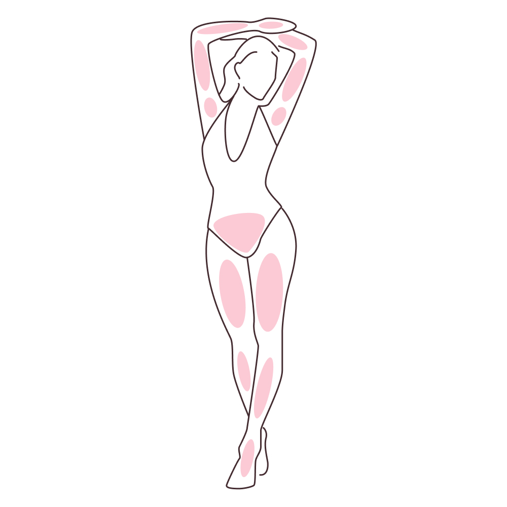 depilacja laserowa całe nogi + całe ręce + bikini głębokie + pachy 